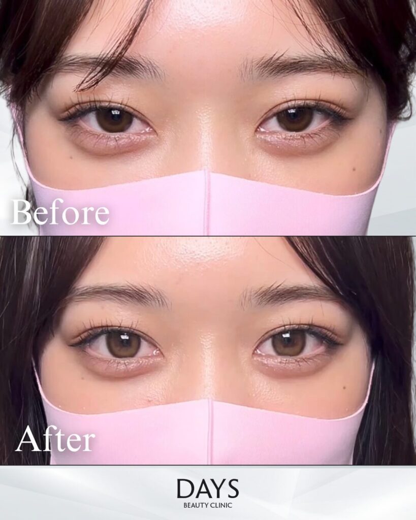 グラマラスライン形成　症例　20代女性