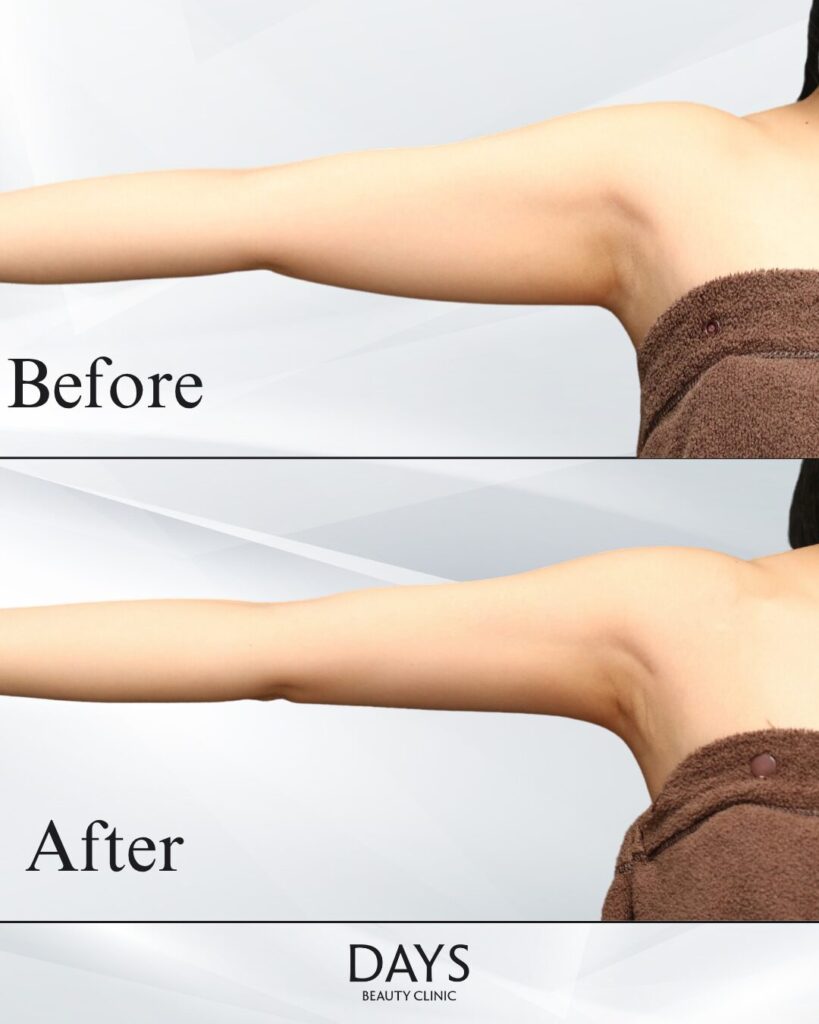 二の腕脂肪吸引　症例　20代女性