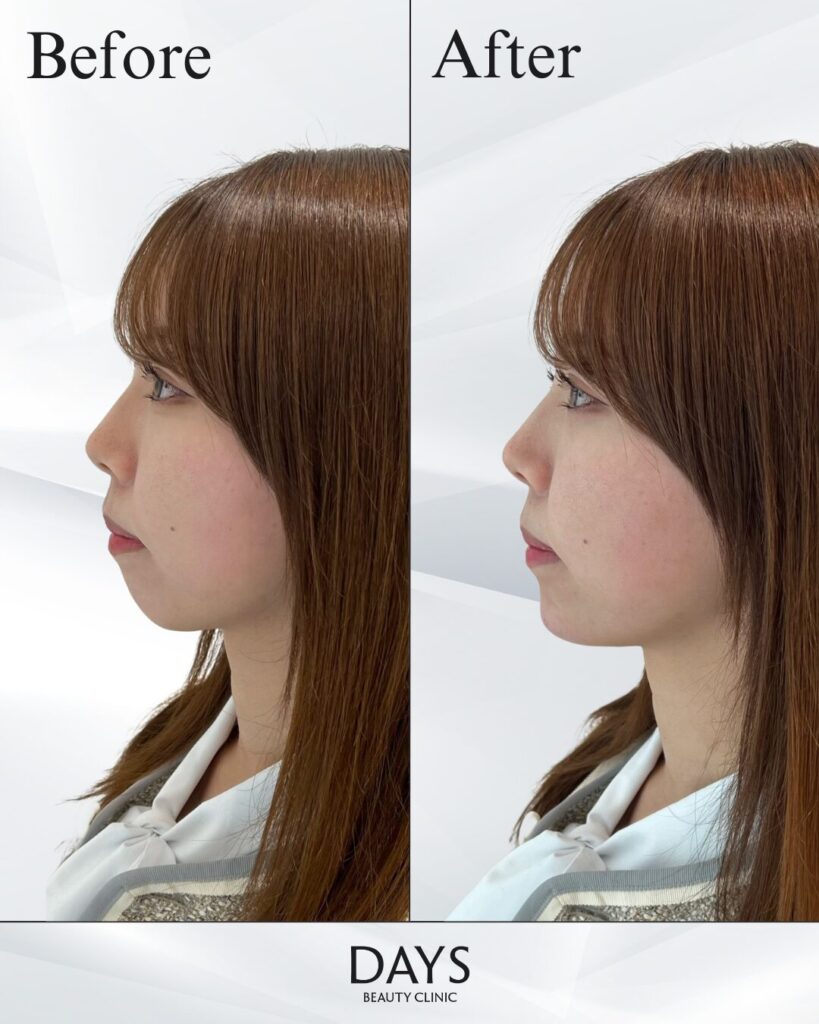 顎ヒアルロン酸　症例　20代女性