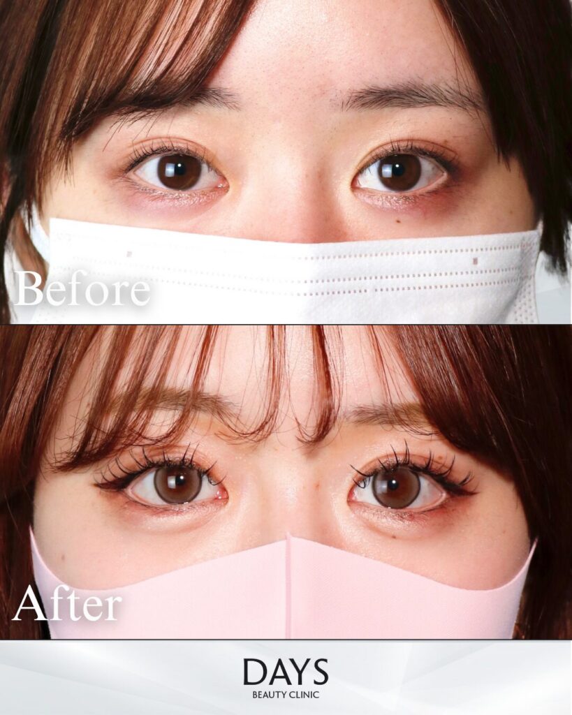 グラマラスライン形成　症例　20代女性