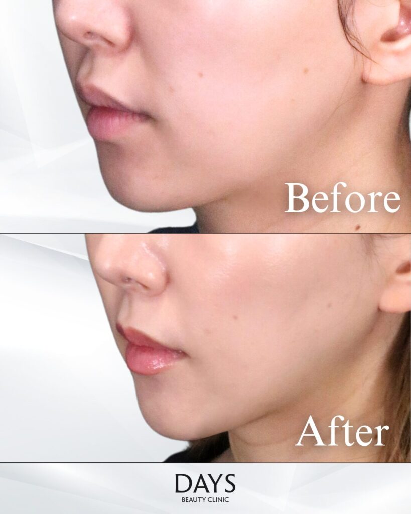 法令線のヒアルロン酸　症例　20代女性