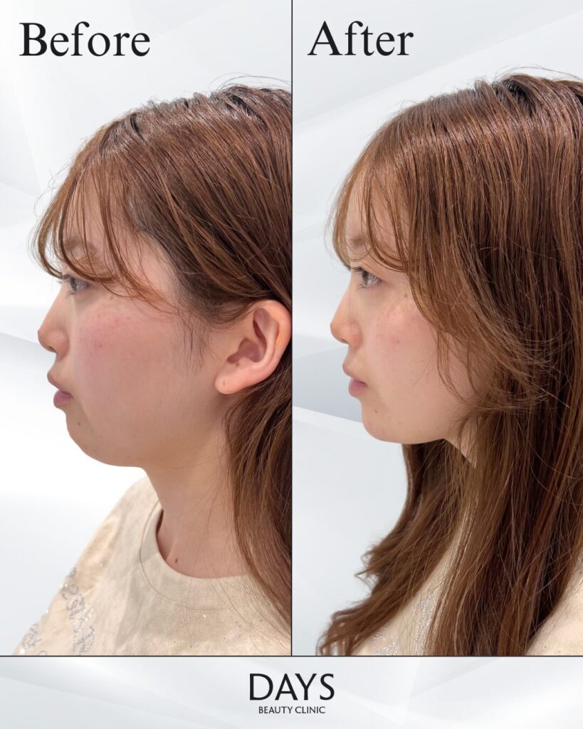 顎のヒアルロン酸　症例　20代女性