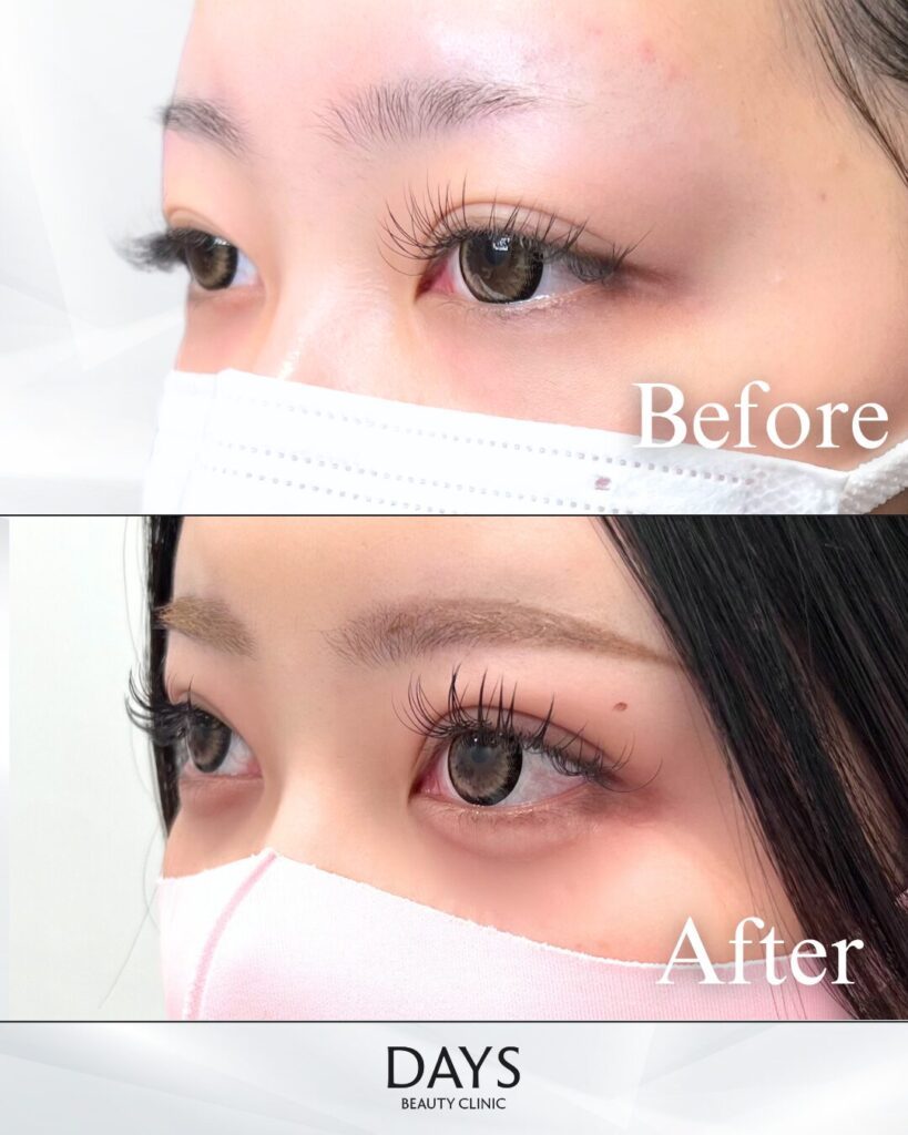 涙袋ヒアルロン酸　症例　20代女性