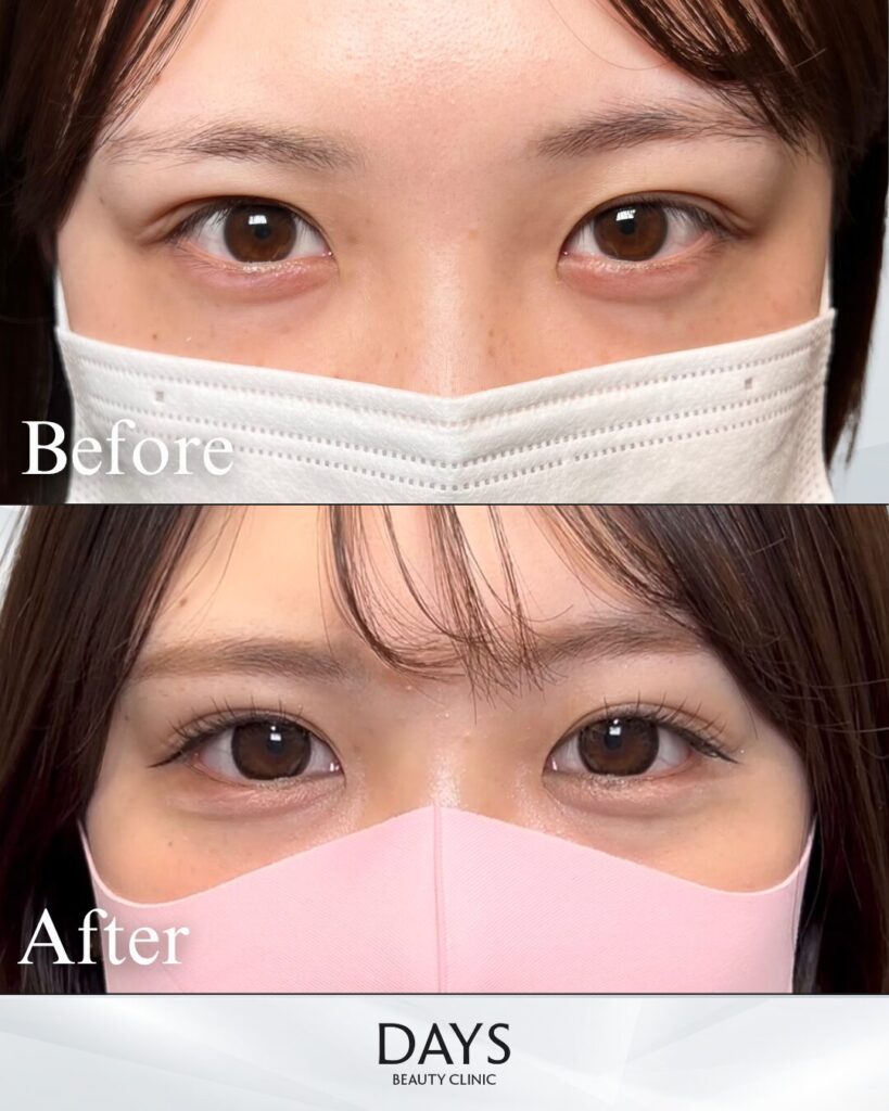 グラマラスライン形成　症例　20代女性