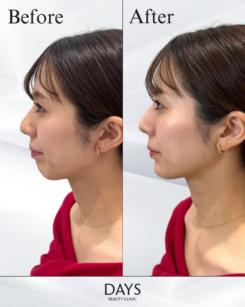 顎のヒアルロン酸　症例　30代女性