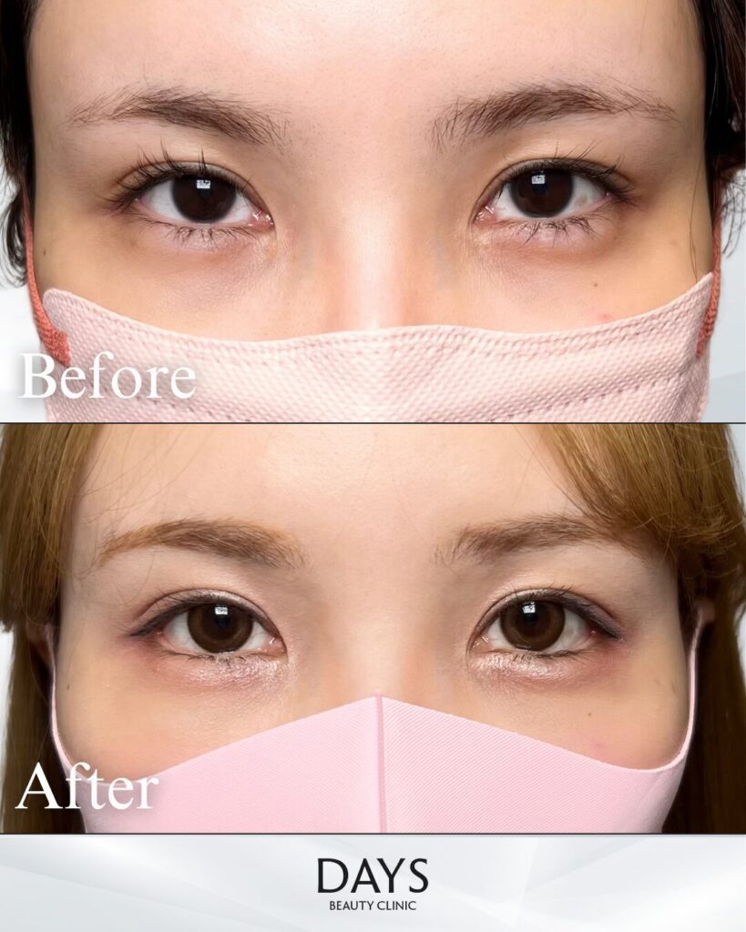 グラマラスライン形成　症例　20代女性