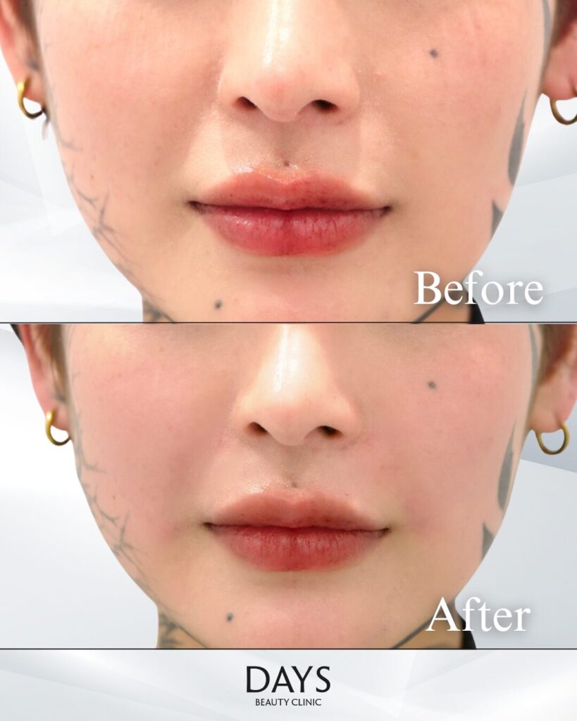 法令線のヒアルロン酸　症例　20代女性