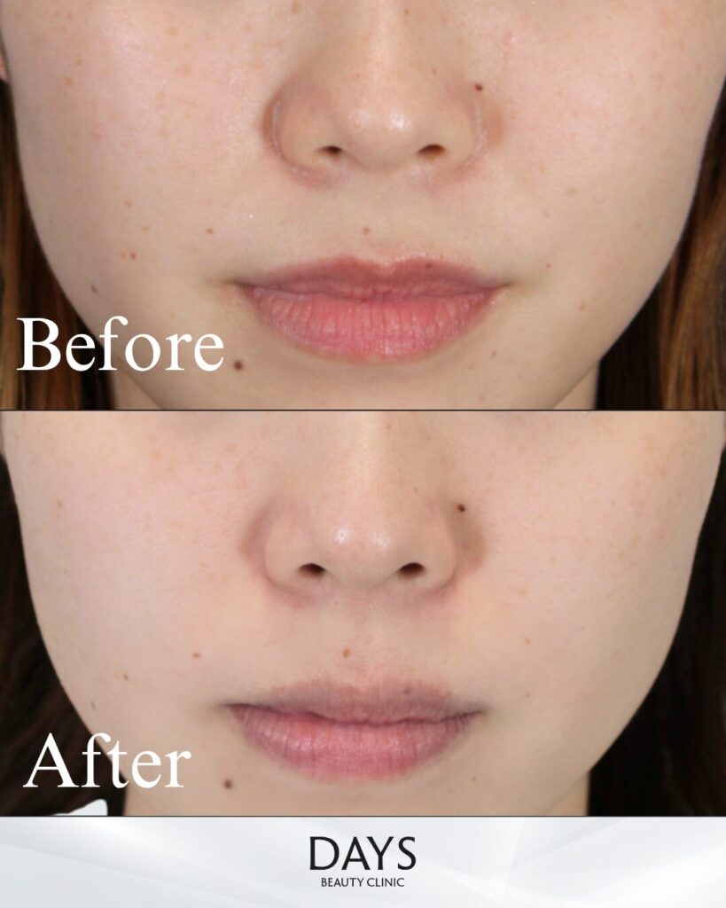 ディスカバリーピコ-ピコトーニング-の症例 20代女性