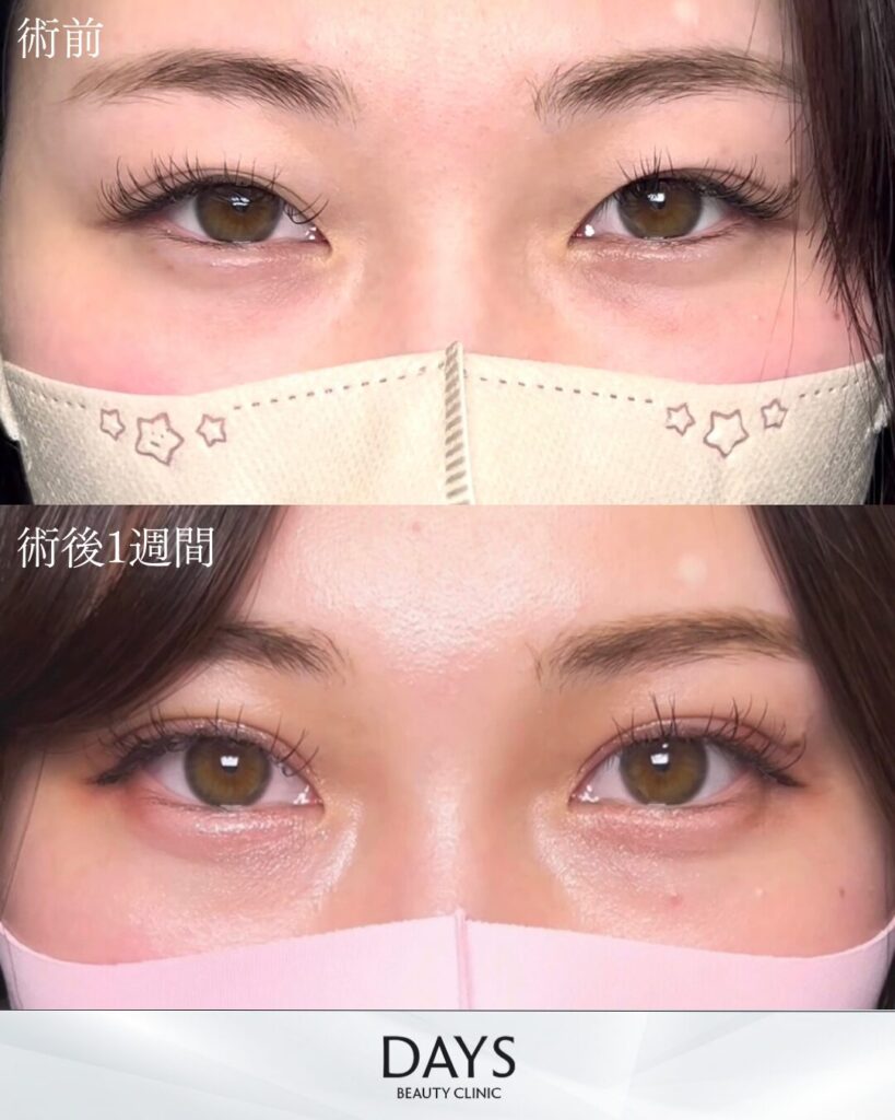 二重埋没　症例　20代女性