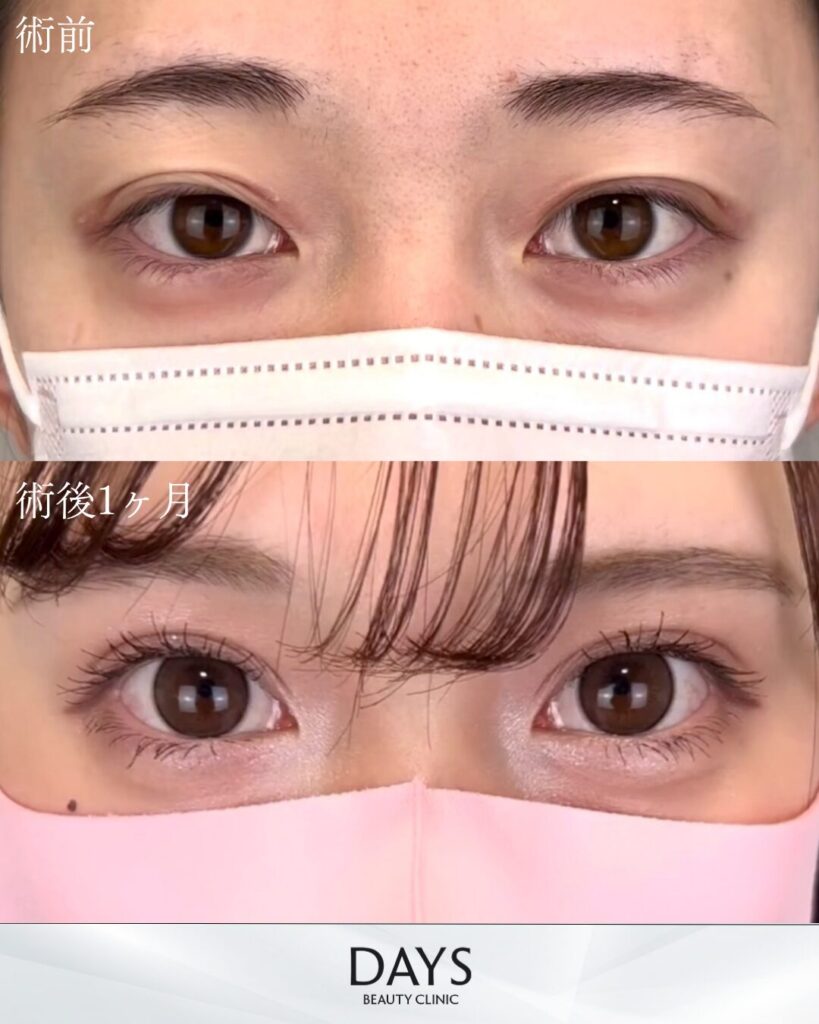 二重埋没　症例　20代女性