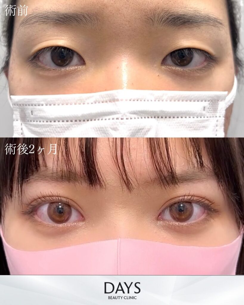 二重埋没　症例　20代女性