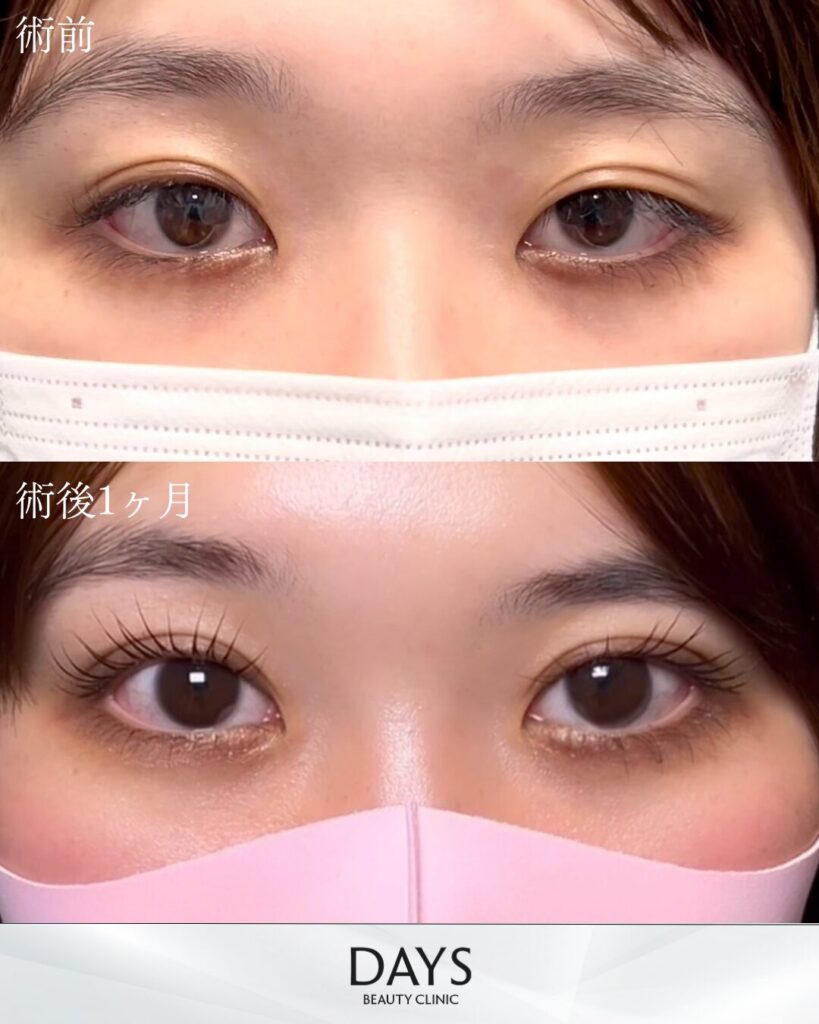 二重埋没　症例　20代女性