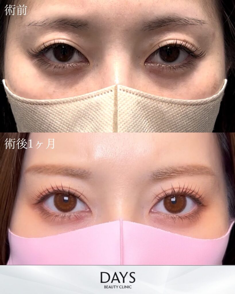 二重埋没　症例　20代女性