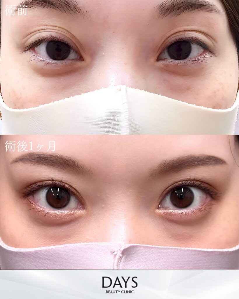 二重埋没　症例　20代女性