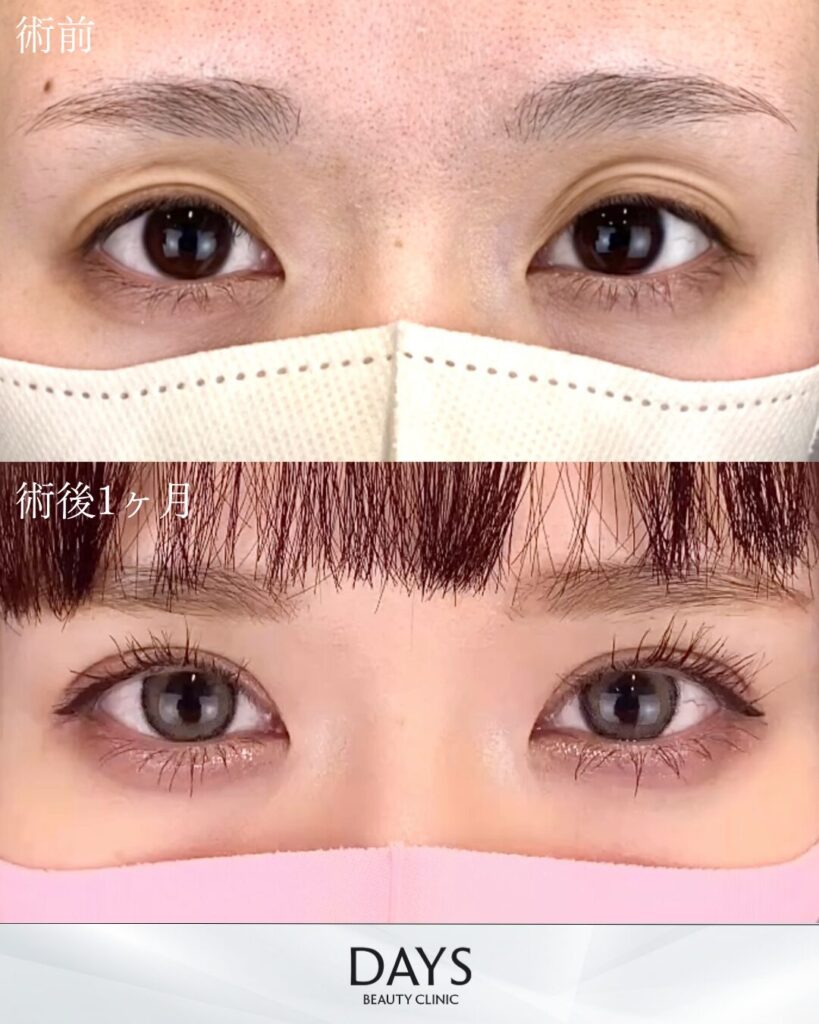 二重埋没　症例　20代女性