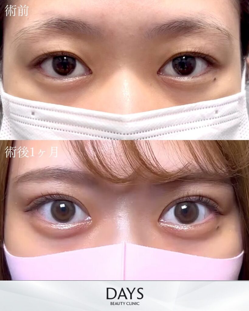 二重埋没　症例　20代女性