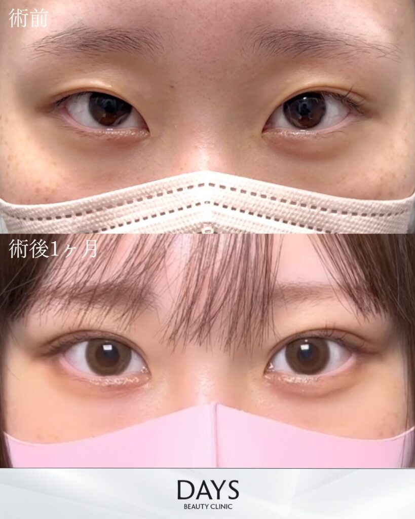 二重埋没　症例　20代女性