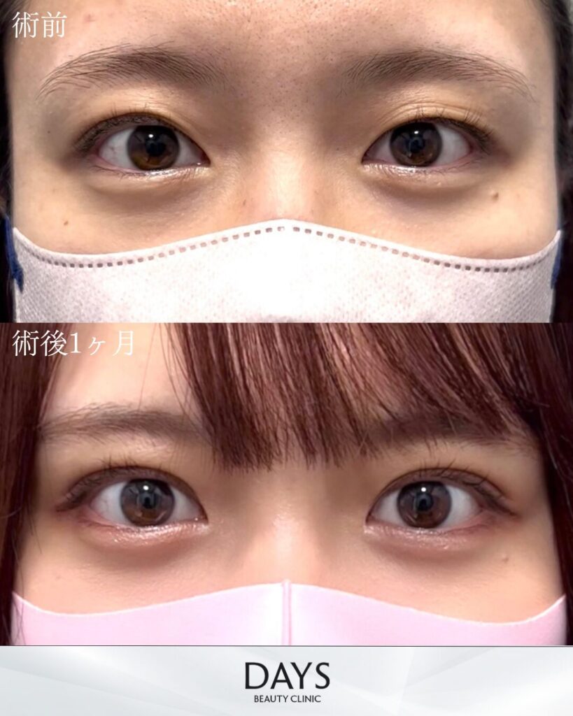 二重埋没　症例　20代女性