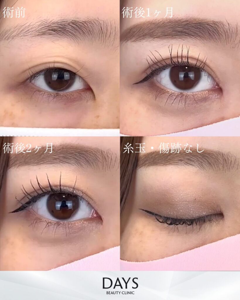 二重埋没　症例　20代女性