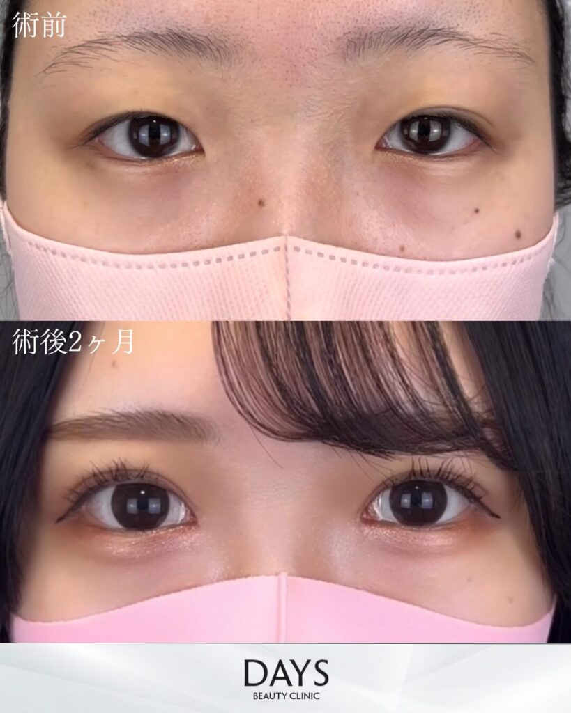 二重埋没　症例　20代女性