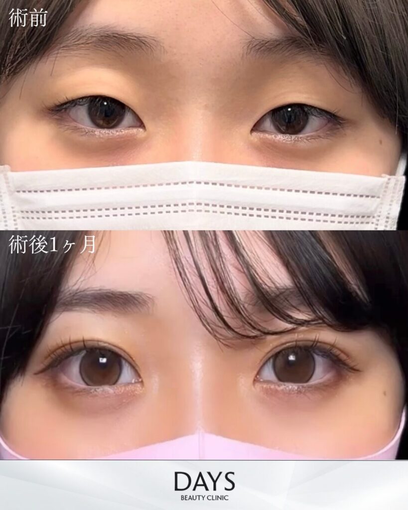 二重埋没　症例　20代女性