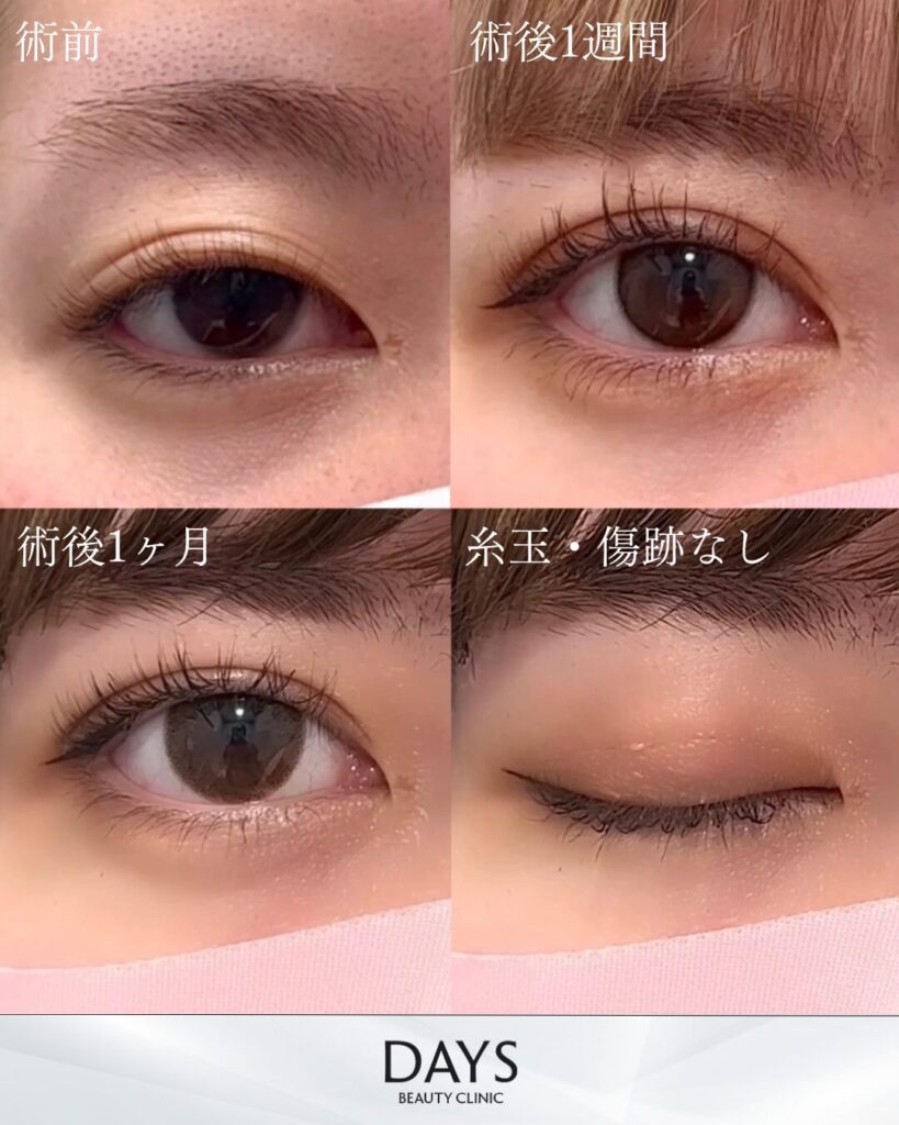 二重埋没　症例　20代女性