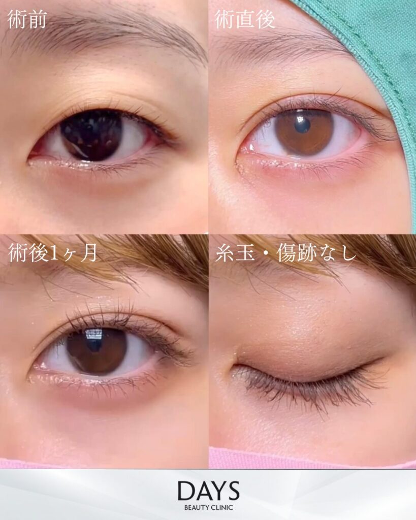 二重埋没　症例　20代女性