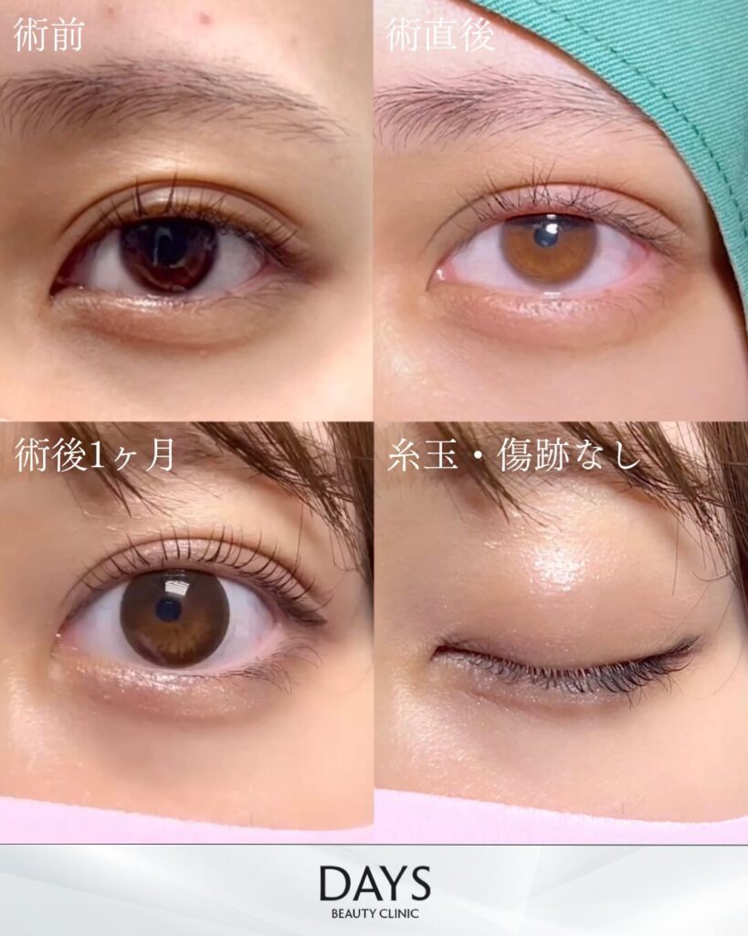 二重埋没　症例　20代女性