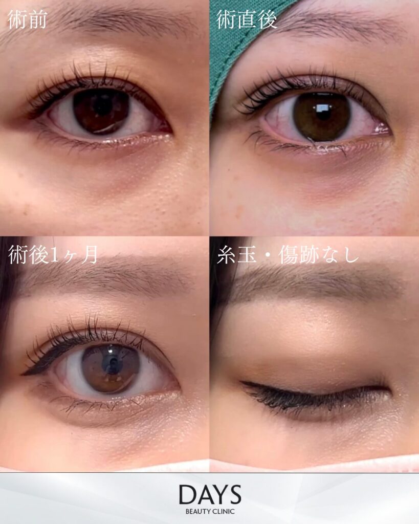 二重埋没　症例　20代女性