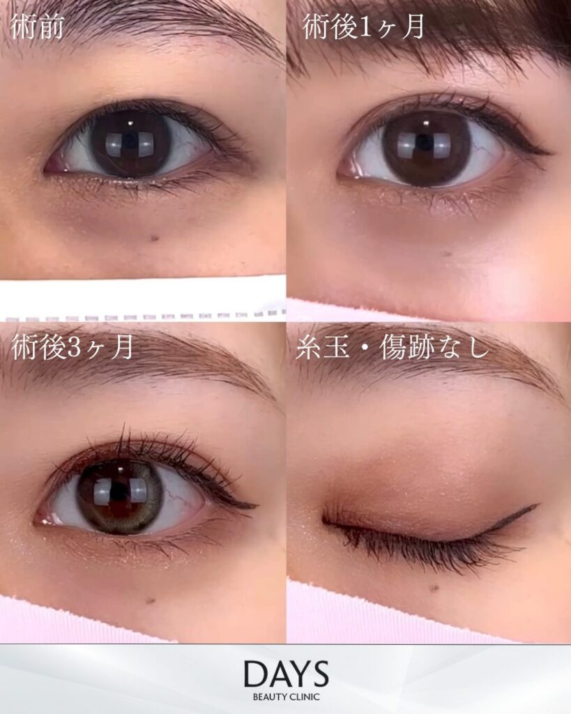 二重埋没　症例　30代女性