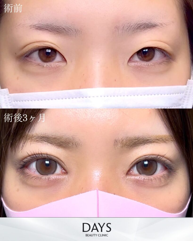 二重埋没　症例　20代女性