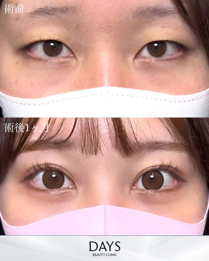 二重埋没　症例　20代女性