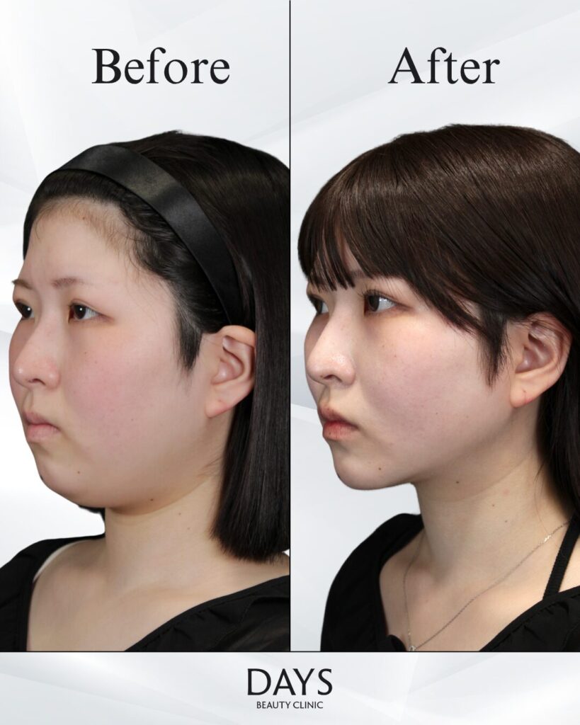 小顔　症例　20代女性