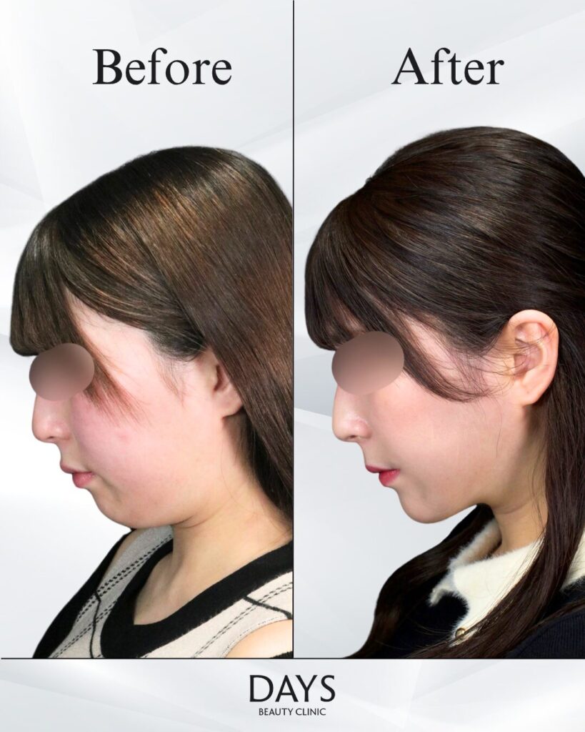 小顔　症例　20代女性