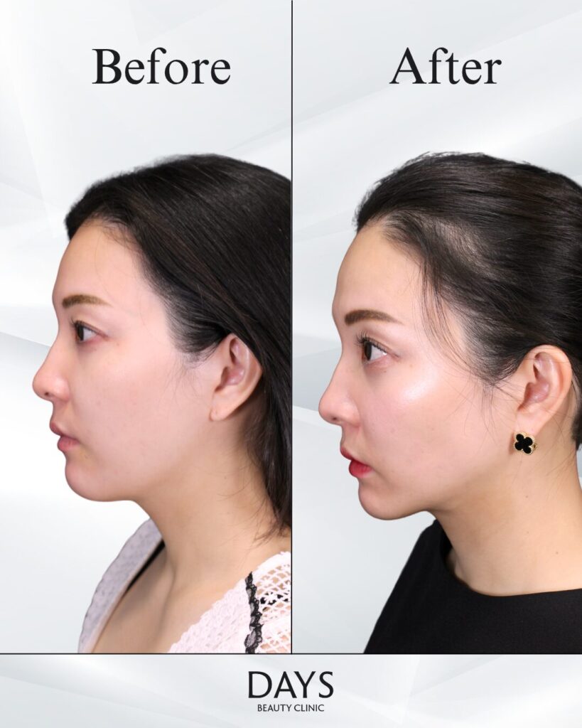 小顔　症例　30代女性