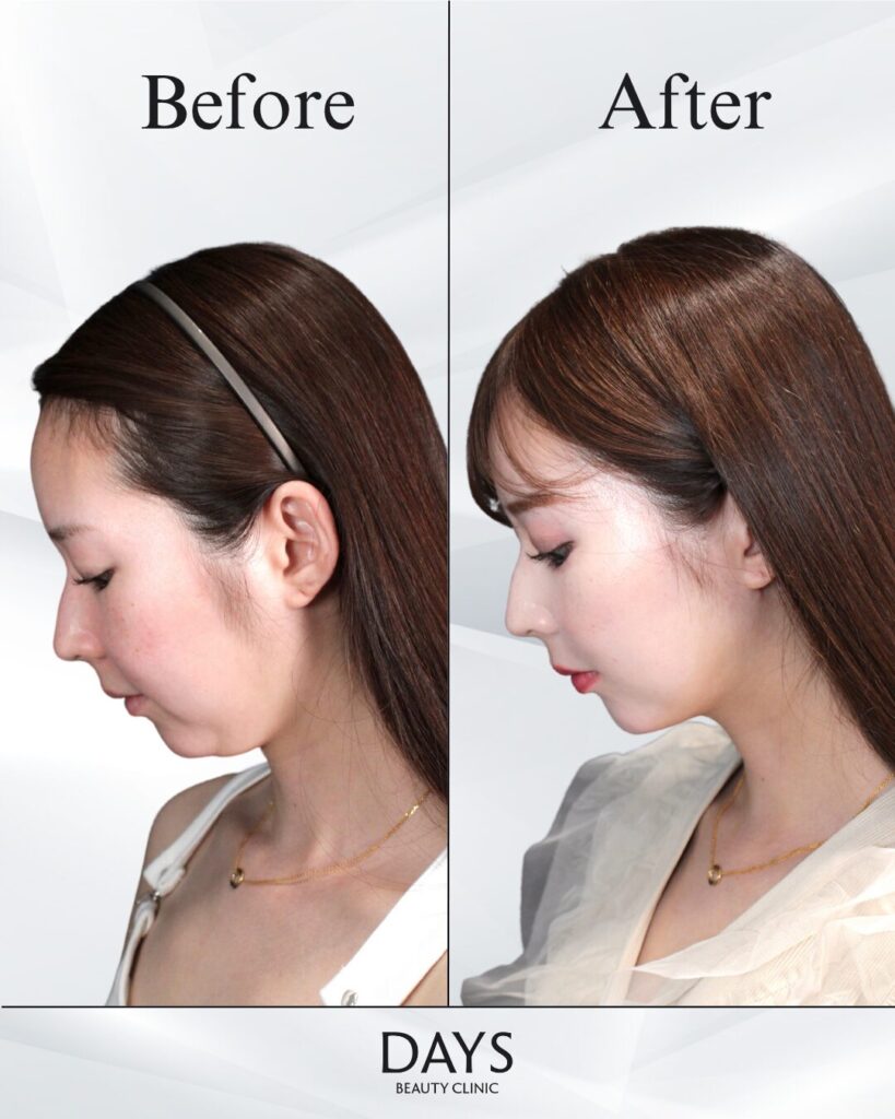 小顔　症例　20代女性