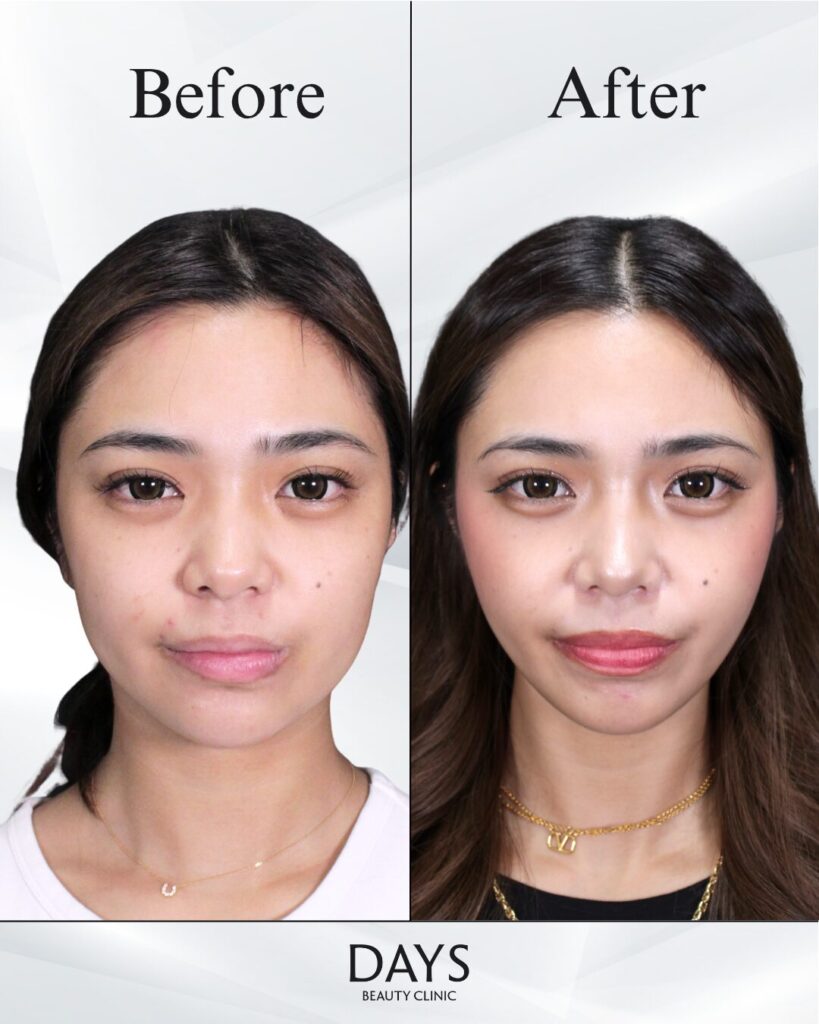 小顔　症例　20代女性