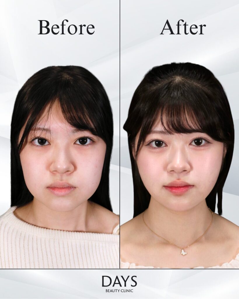 小顔　症例　20代女性