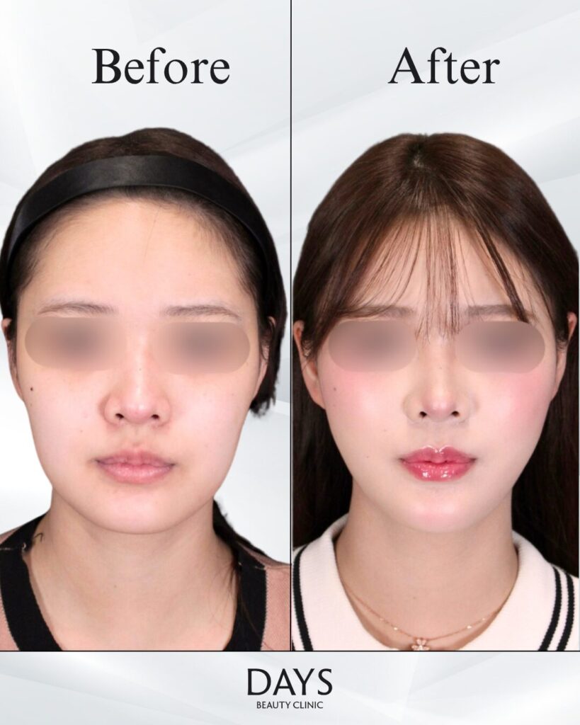 小顔　症例　20代女性