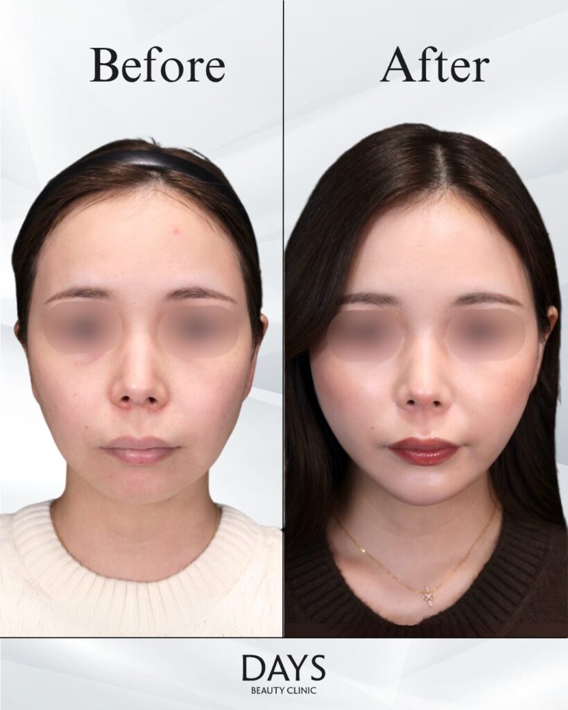 小顔　症例　30代女性