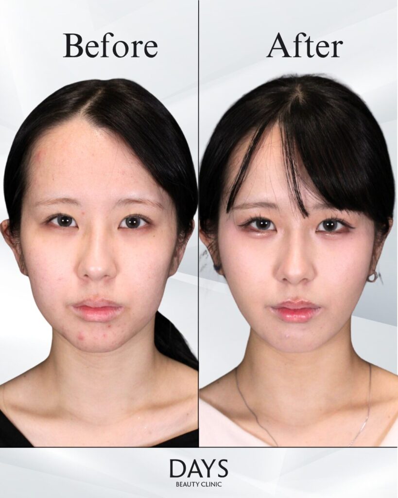 小顔　症例　20代女性