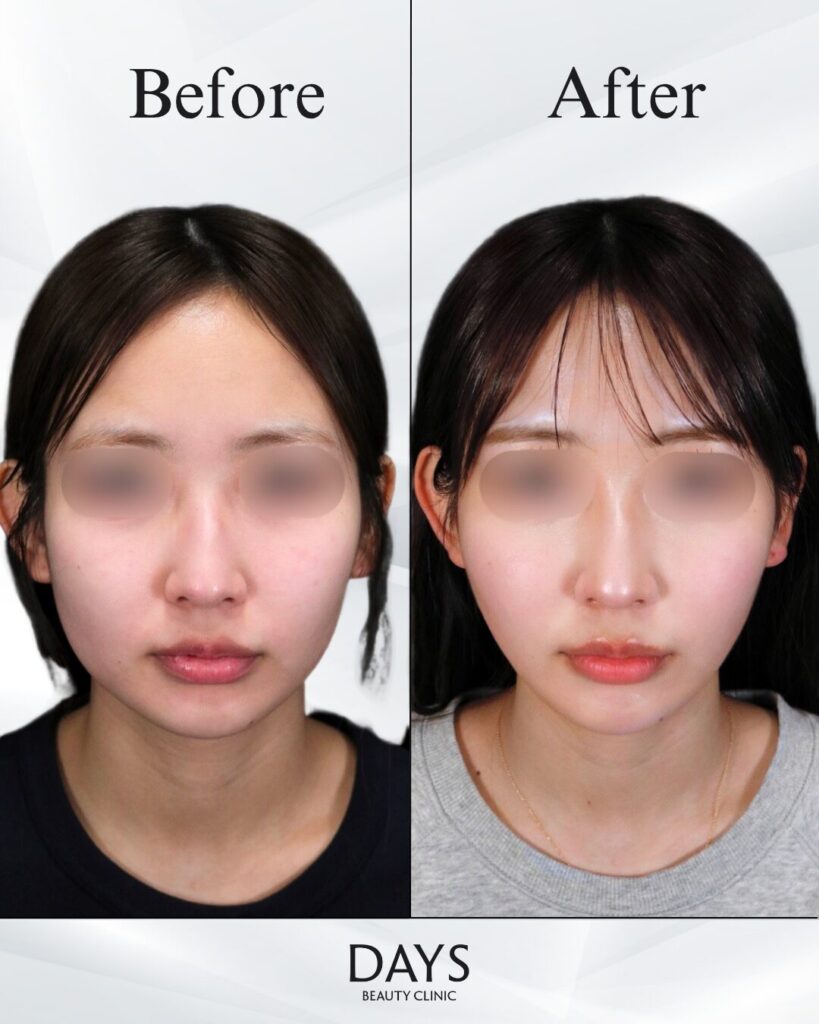 小顔　症例　20代女性