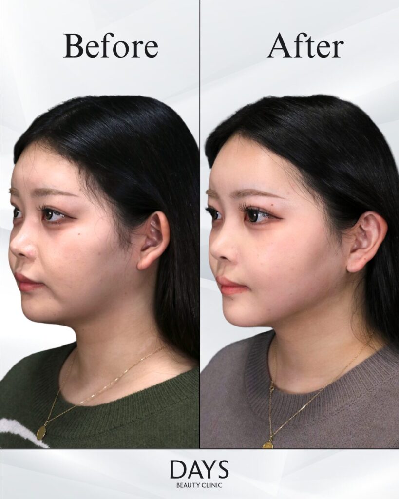 小顔　症例　20代女性