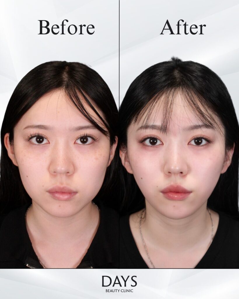 小顔　症例　20代女性