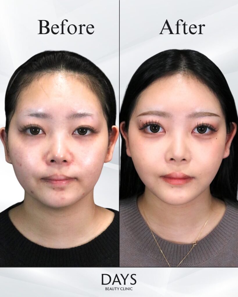 小顔　症例　20代女性