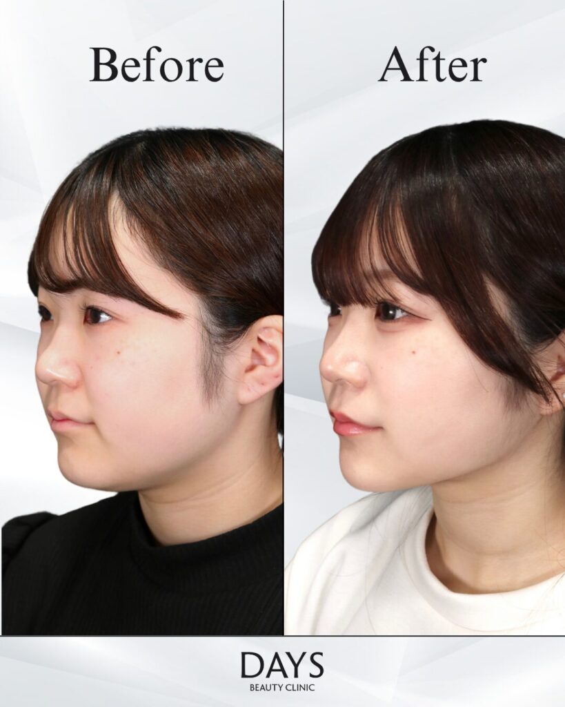 小顔　症例　20代女性　