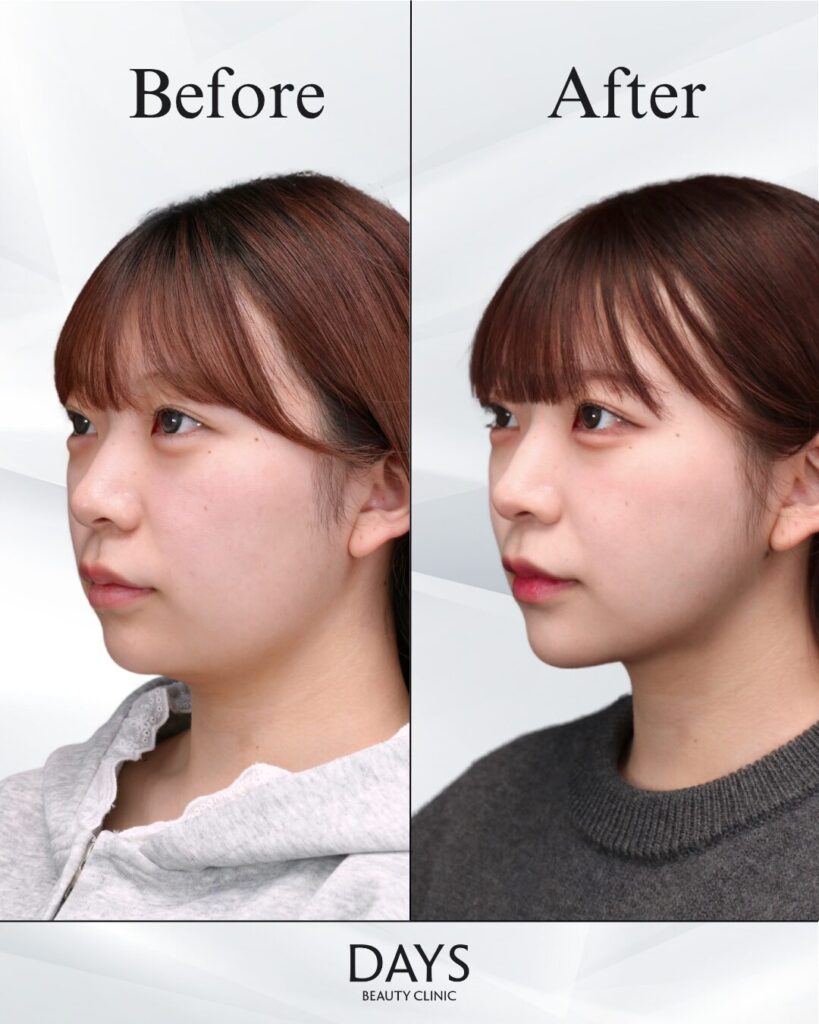 小顔　症例　20代女性