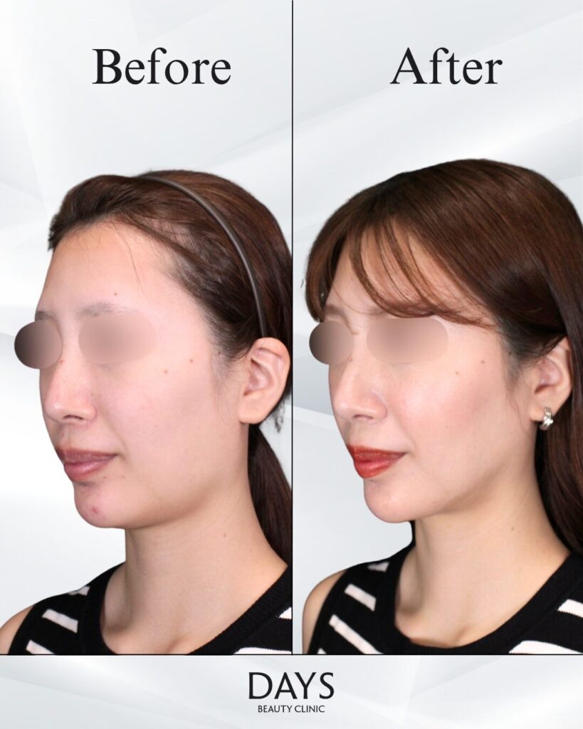 小顔　症例　30代女性