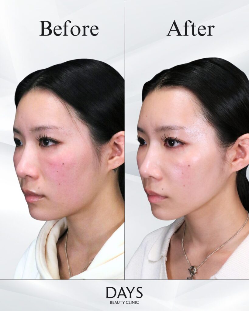 小顔　症例　30代女性