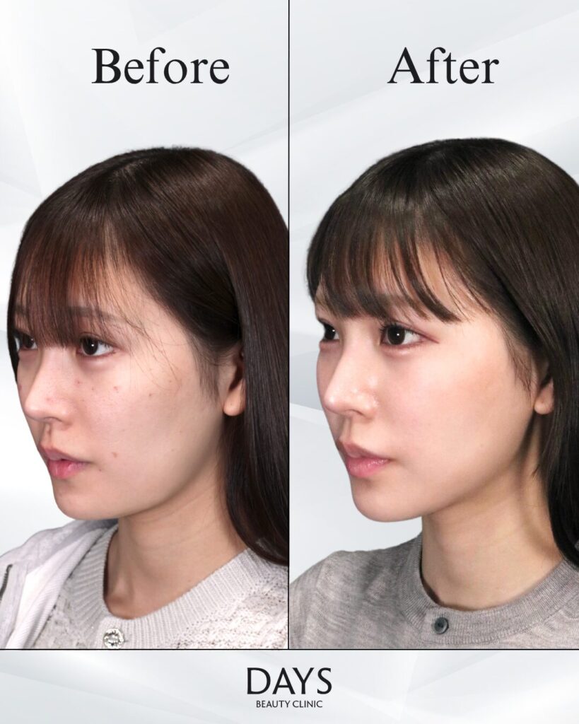 小顔　症例　20代女性